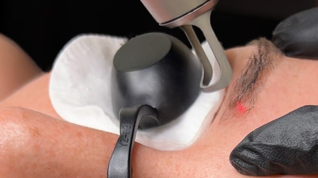 Laserfjernelse af bryn-min